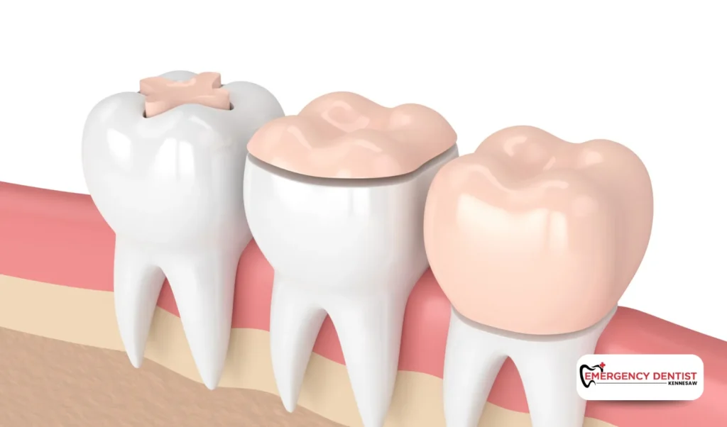 What Causes Root Canal Treatment to Be Necessary