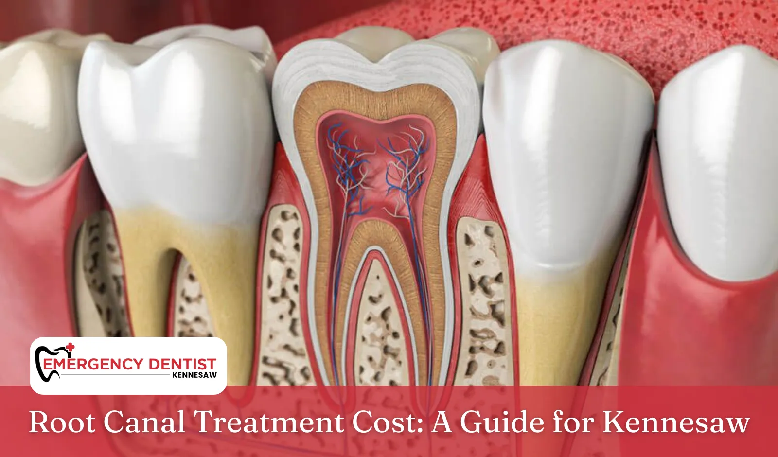 Root Canal Treatment Cost A Guide for Kennesaw