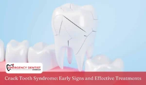 Crack Tooth Syndrome Early Signs and Effective Treatments