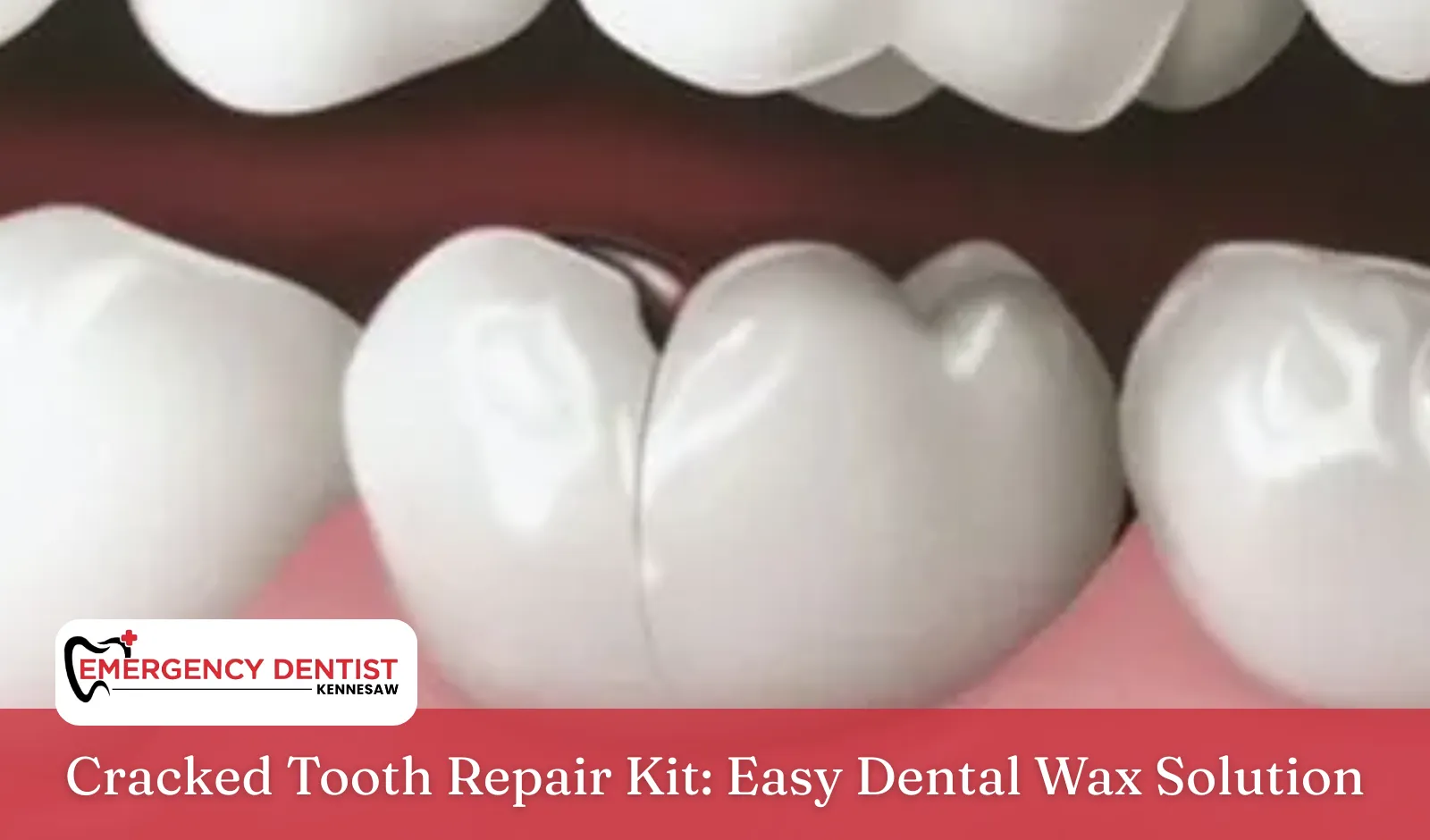 Cracked Tooth Repair Kit Easy Dental Wax Solution