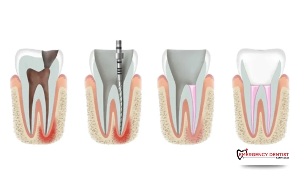 Treatments to Repair a Broken Tooth