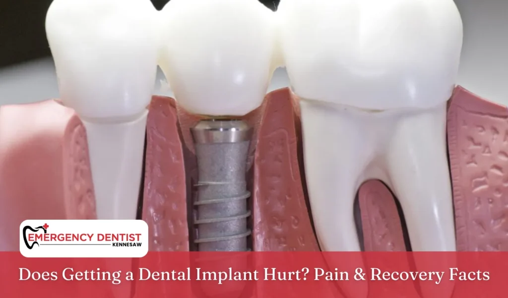 Does Getting a Dental Implant Hurt Pain & Recovery Facts