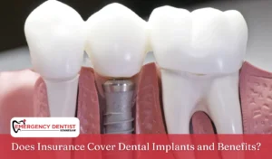Does Insurance Cover Dental Implants and Benefits