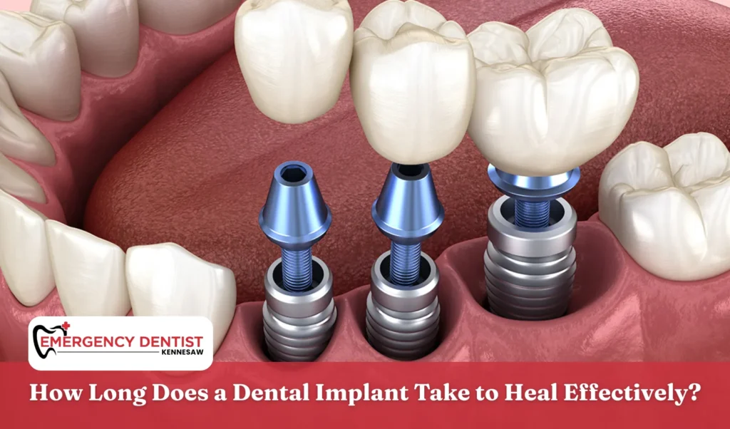 How Long Does a Dental Implant Take to Heal Effectively