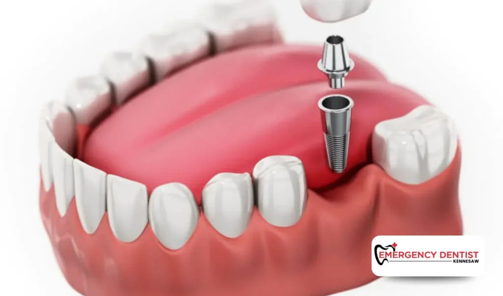 What Are Dental Implants and Why Are They Needed
