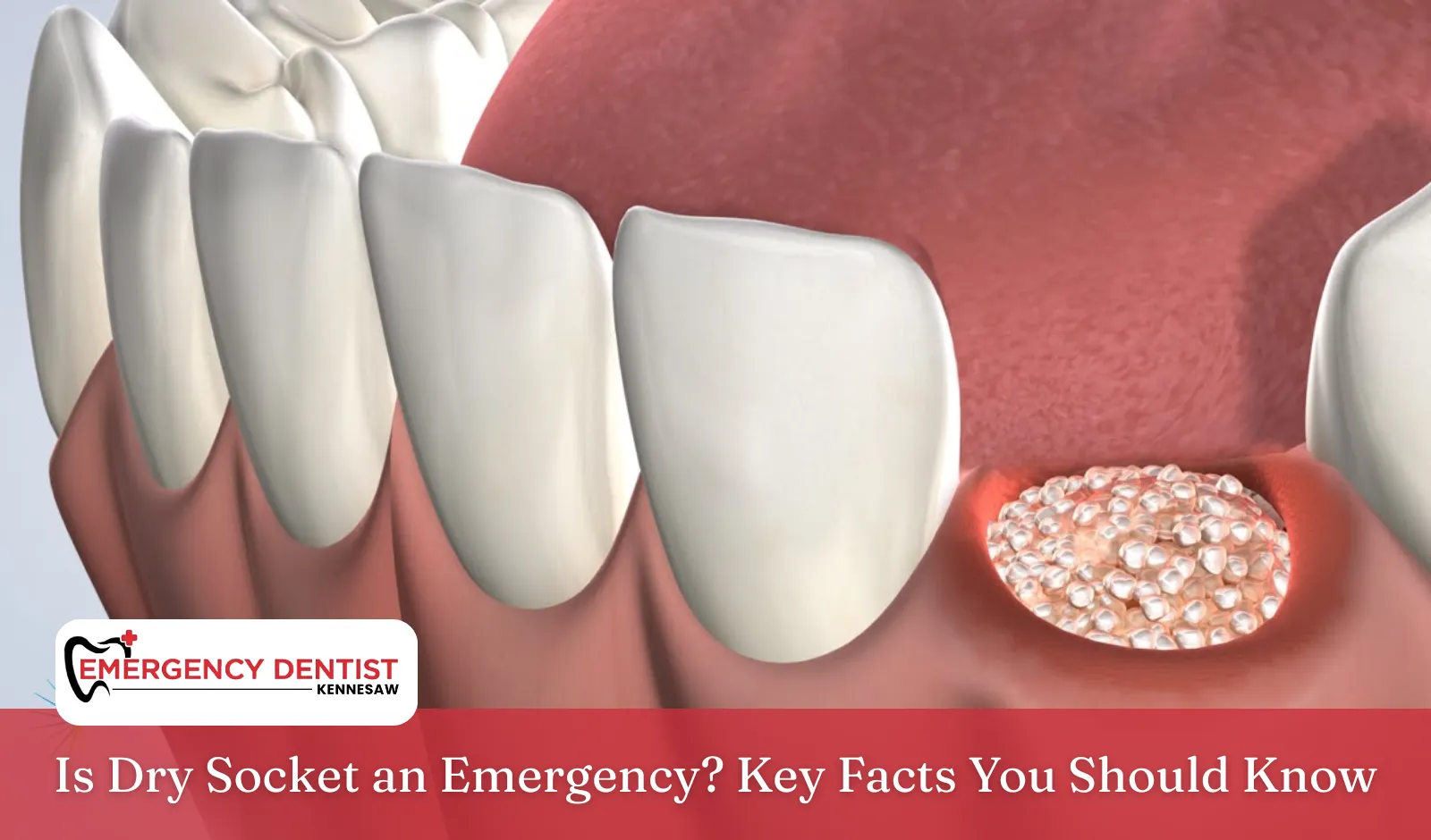 Is Dry Socket an Emergency? Key Facts You Should Know Is Dry Socket an Emergency? Key Facts You Should Know
