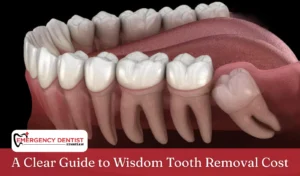 A Clear Guide to Wisdom Tooth Removal Cost