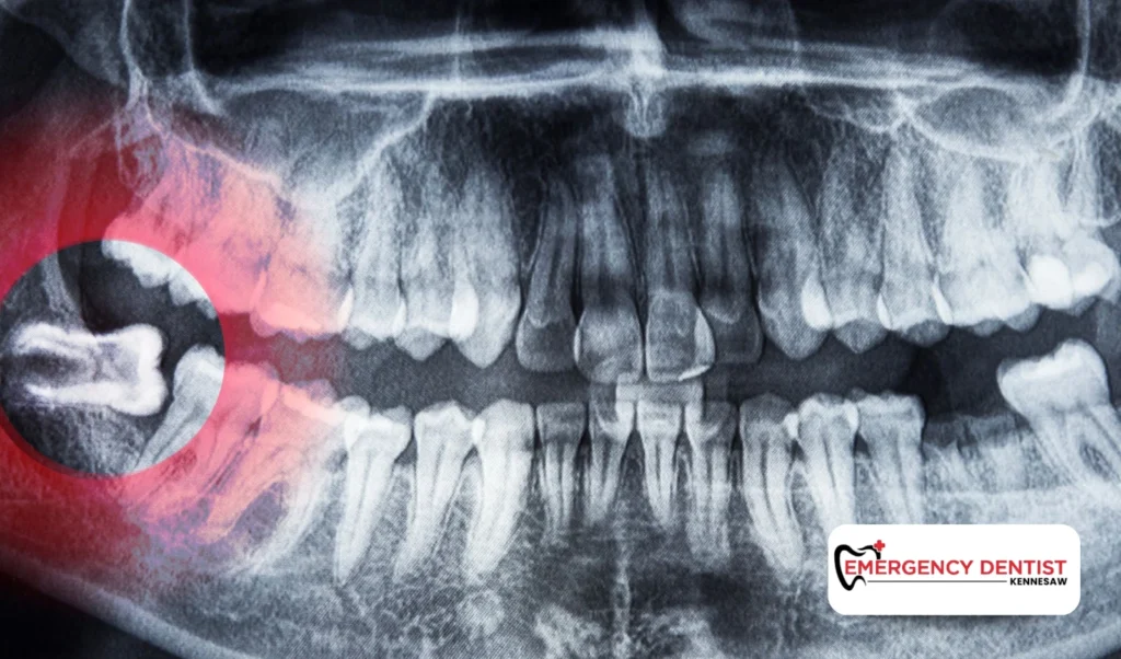 How to Get Accurate Wisdom Tooth Removal Cost
