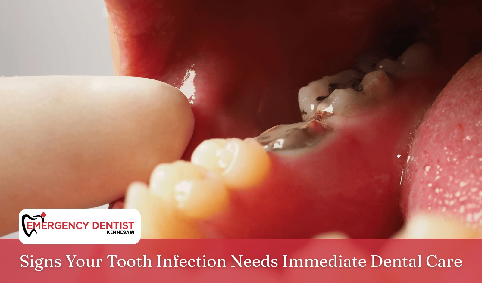 Signs Your Tooth Infection Needs Immediate Dental Care
