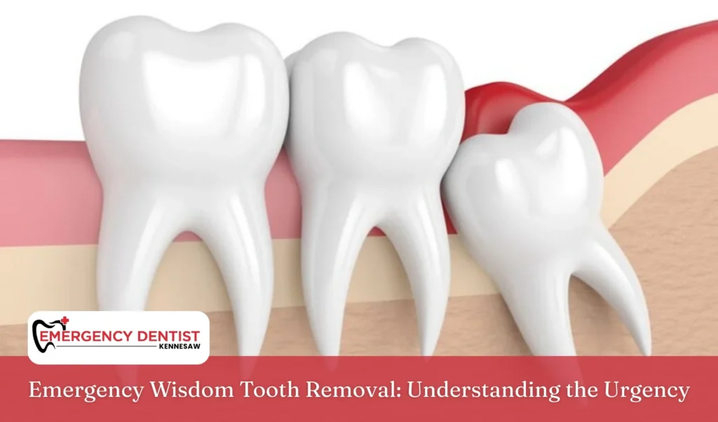 Emergency Wisdom Tooth Removal Understanding the Urgency
