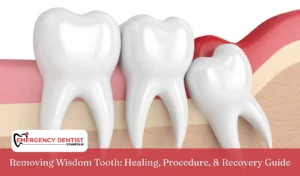 Removing Wisdom Tooth Healing, Procedure, & Recovery Guide