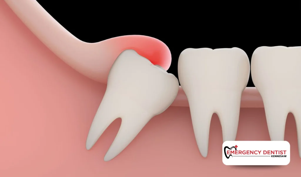 Why Wisdom Teeth Are Removed