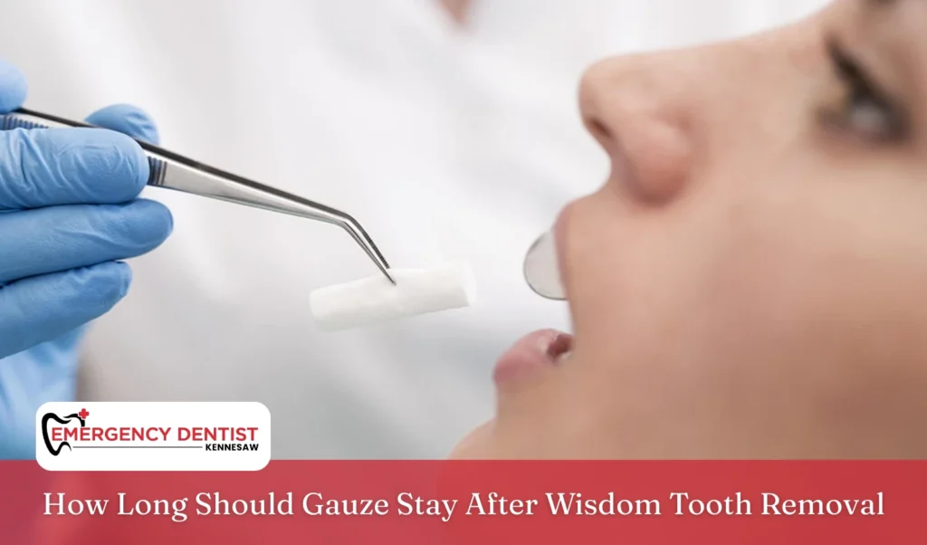 How Long Should Gauze Stay After Wisdom Tooth Removal