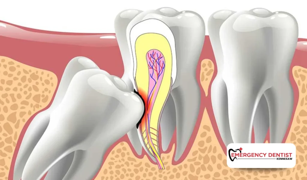 Why Wisdom Tooth Removal Is Often Necessary
