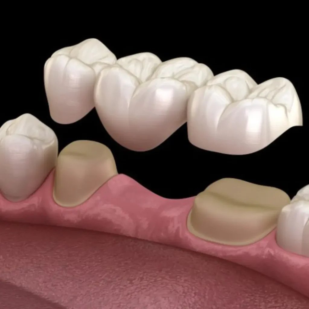 Accidental-damage-from-injury-or-biting-down-Kennesaw-GA