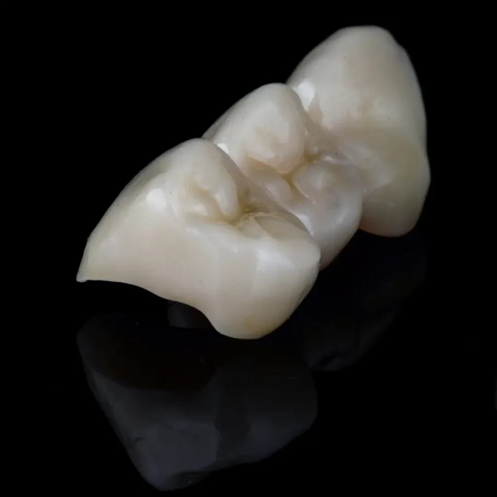 Broken-or-cracked-dental-bridge-Kennesaw-GA
