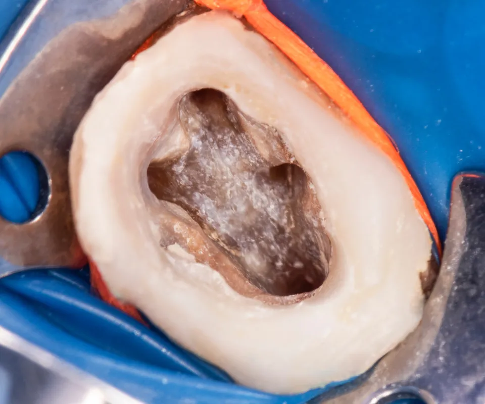 Cleaning-the-Root-Canal-Kennesaw-GA