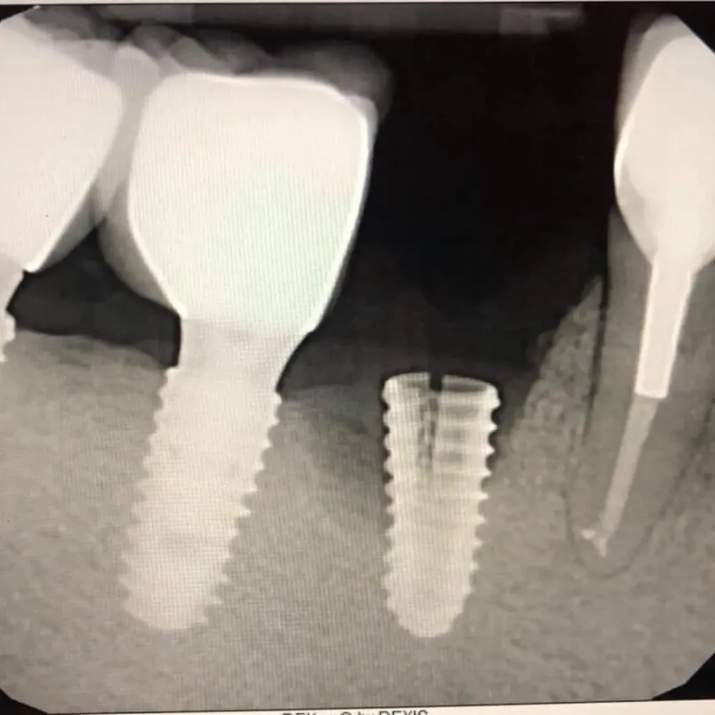 Cracked-or-fractured-implants-Kennesaw-GA