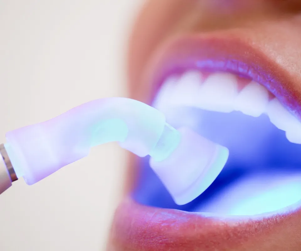 Dental-Bonding-or-Filling-Kennesaw-GA