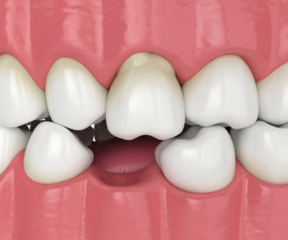 Dislocated-Teeth-Kennesaw-GA