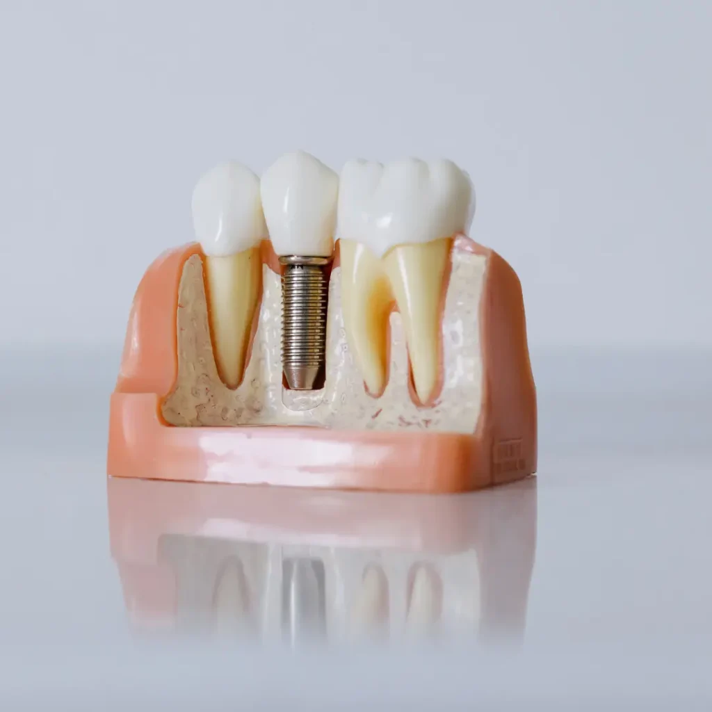 Emergency-Dental-Implant-in-Kennesaw-GA