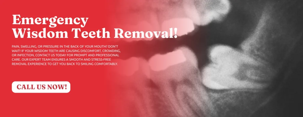 Emergency-Wisdom-tooth-Removal-Kennesaw-GA