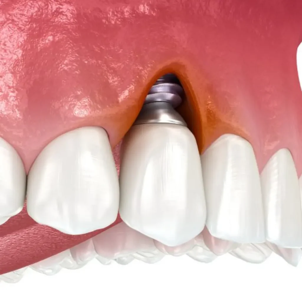 Infection-or-pain-around-an-implant-Kennesaw-GA