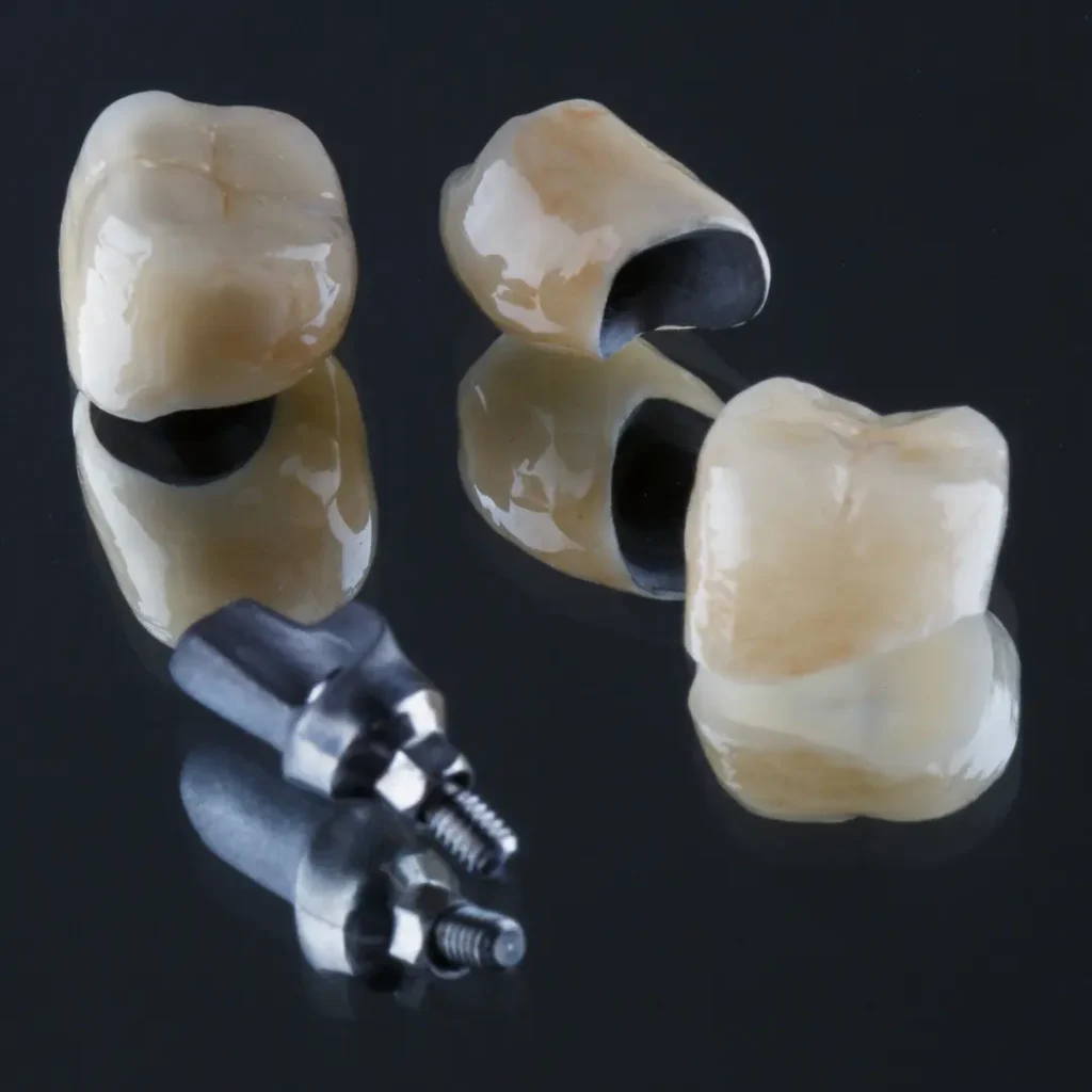Loose-dental-bridge-or-crown-Kennesaw-GA