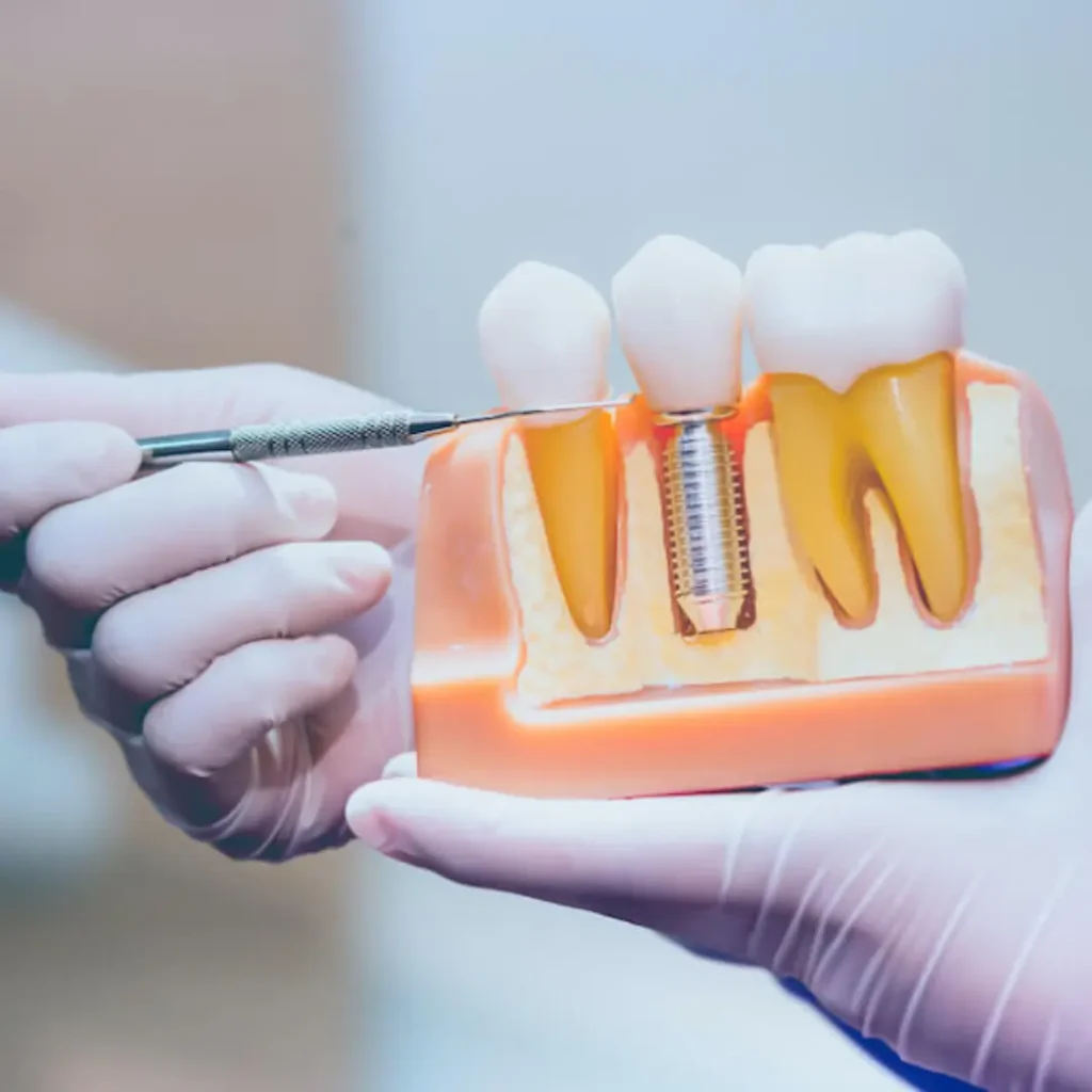 Loose-or-shifting-dental-implants-Kennesaw-GA