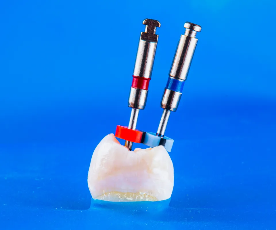 Root-Canal-Treatment-Kennesaw-GA