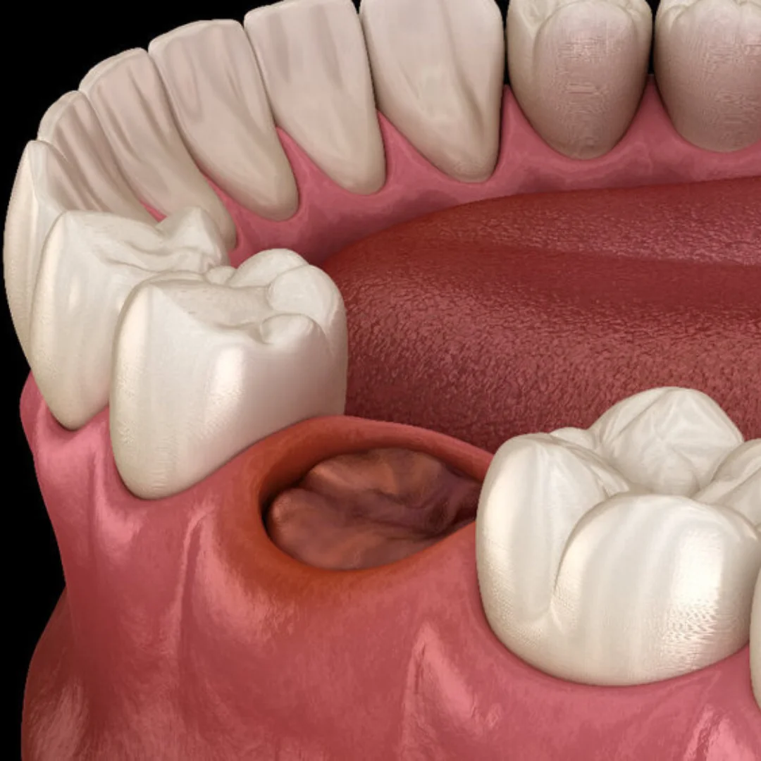Symptoms-of-Dry-Socket-Kennesaw-GA