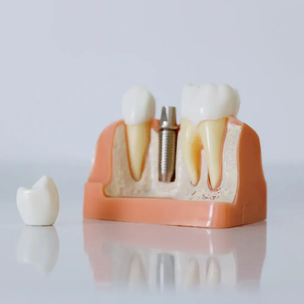 The-implant-crown-fell-off-or-broke-Kennesaw-GA