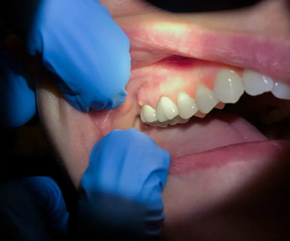 Tooth-Abscess-Kennesaw-GA