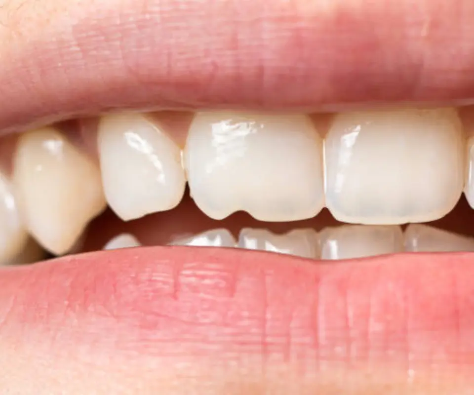 Tooth-Fractures-Kennesaw-GA