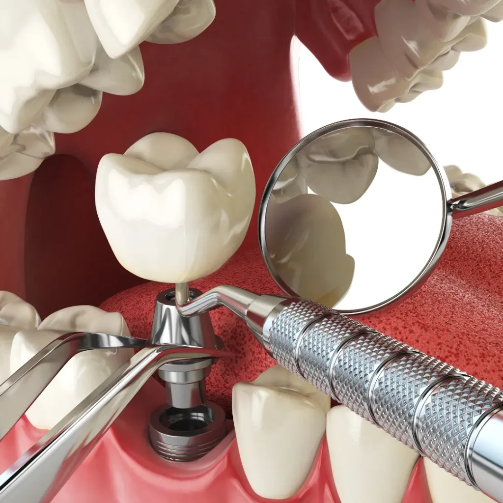 Trauma-related-tooth-loss-needs-immediate-implants-Kennesaw-GA