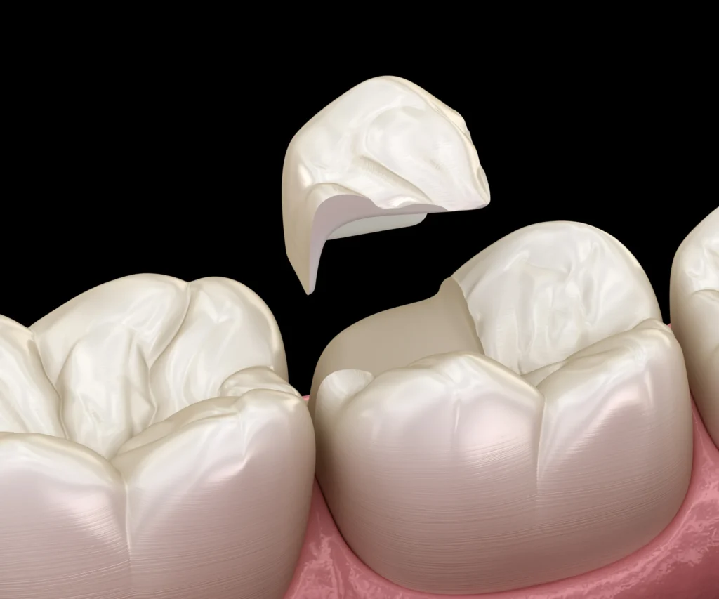 What-Causes-a-Cracked-Tooth-Kennesaw-GA