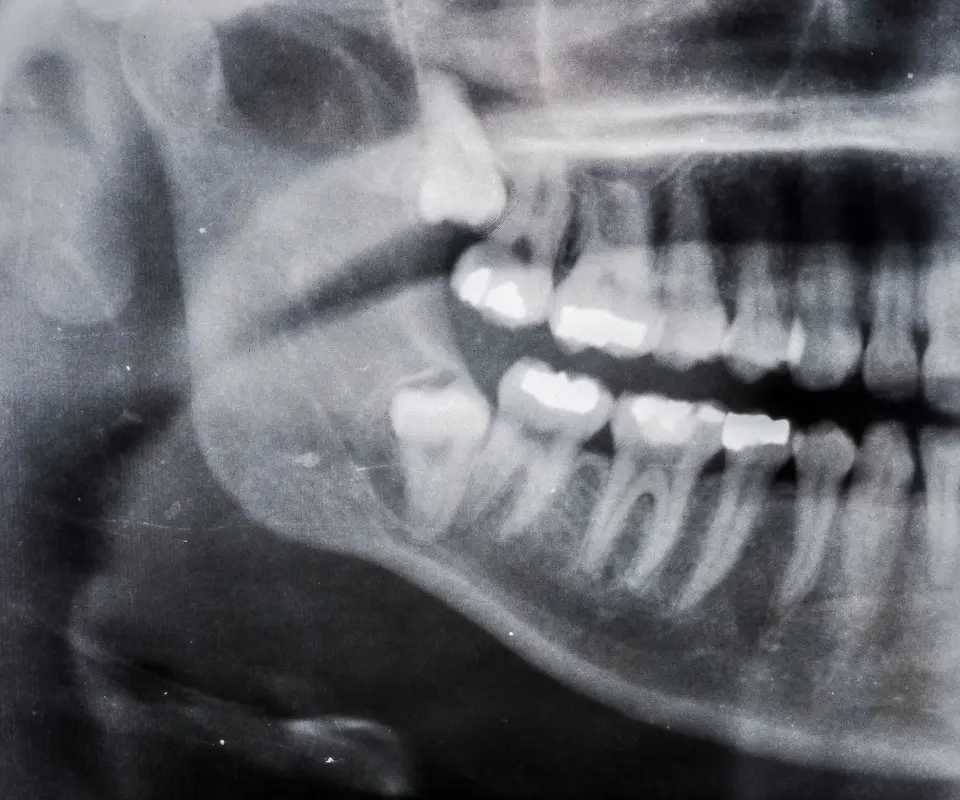 Wisdom-Tooth-Complications-Kennesaw-GA