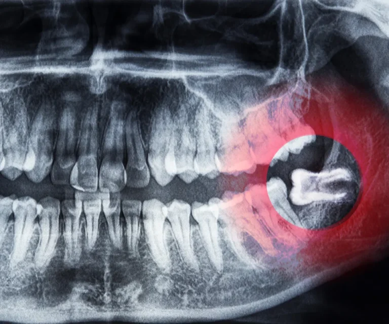 Wisdom-Tooth-Infection-Emergencies-Kennesaw-GA