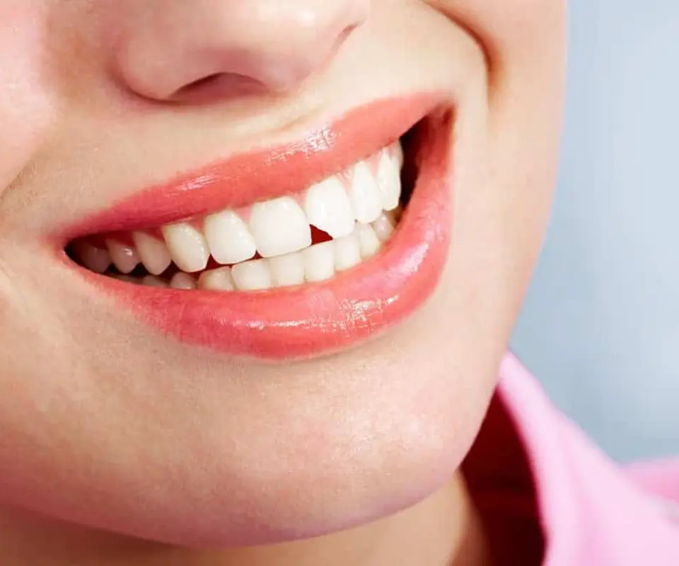 Chipped-Teeth-Kennesaw-GA