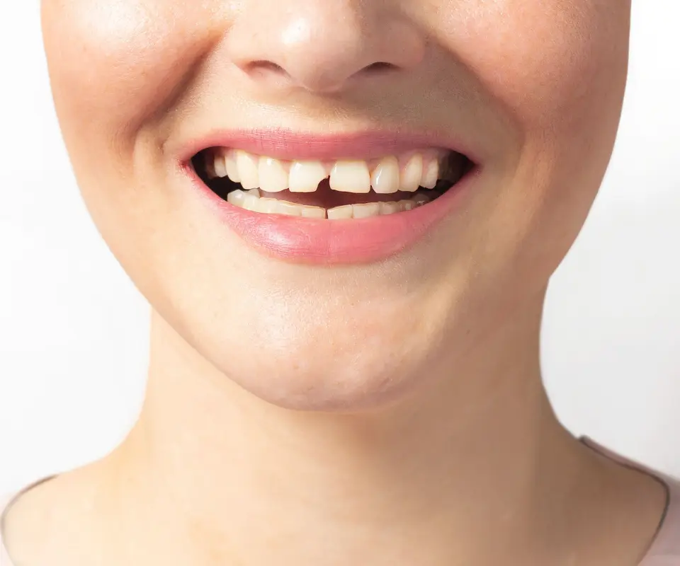 Cracked-or-Broken-Teeth-Kennesaw-GA