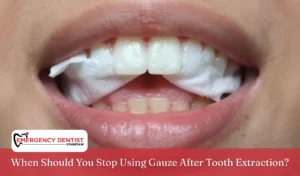 when-to-stop-using-gauze-after-extraction