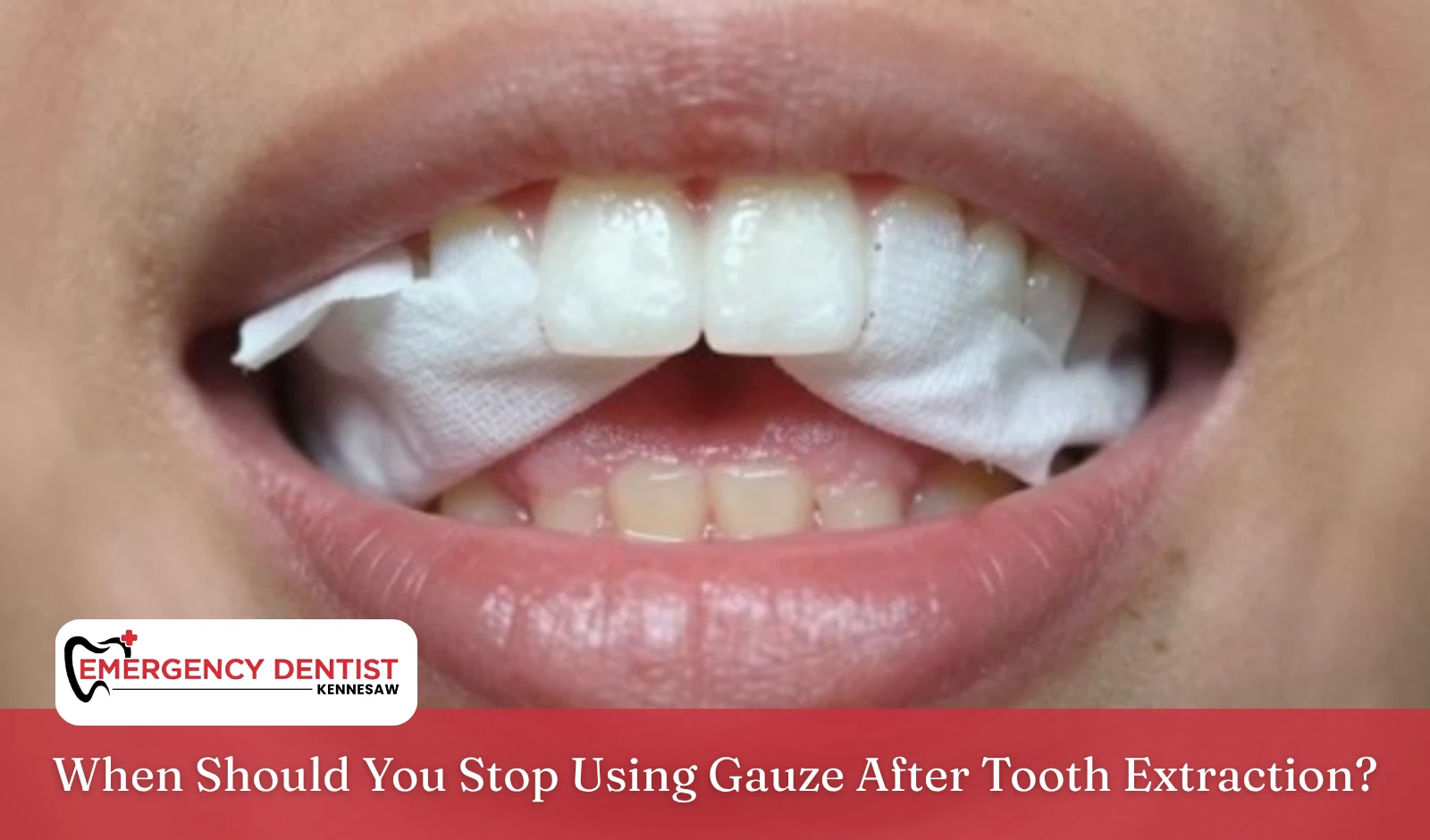 when-to-stop-using-gauze-after-extraction