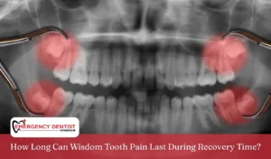 wisdom-tooth-pain-recovery-time