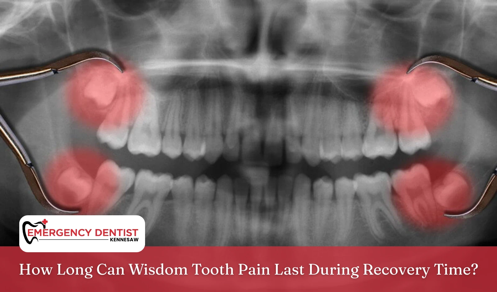 wisdom-tooth-pain-recovery-time