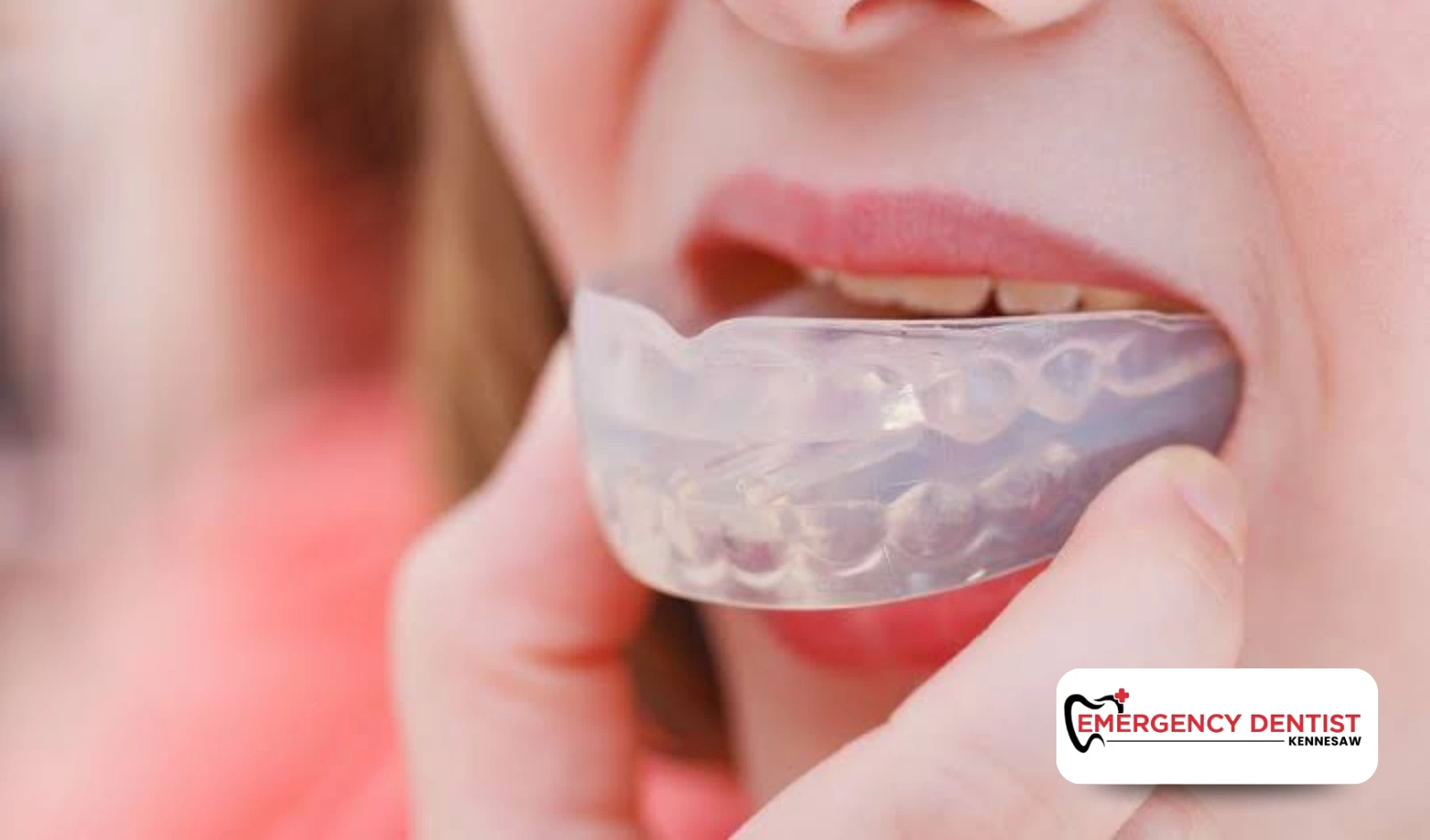 Using Mouthguards to Protect the Teeth