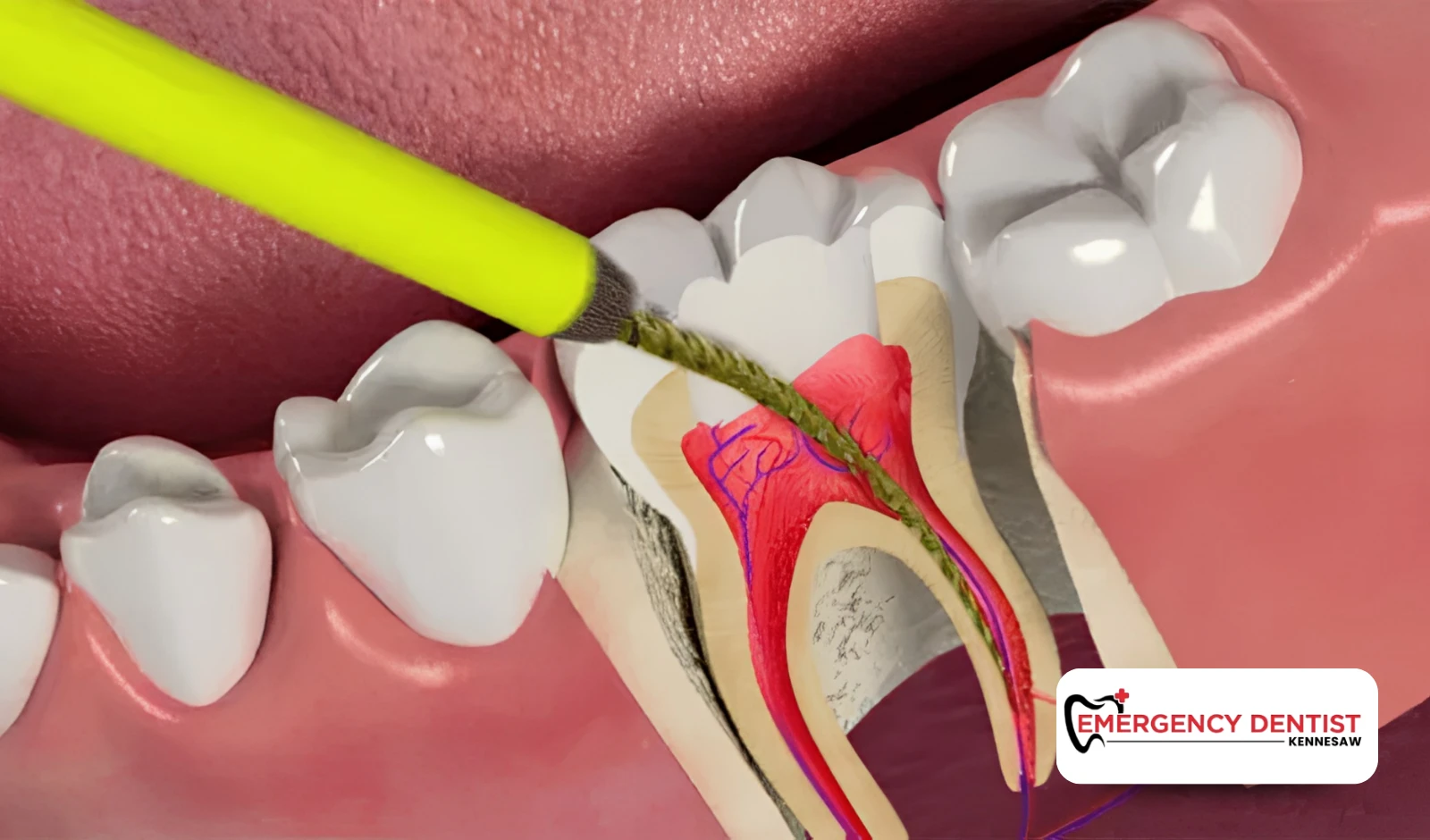 What Can Influence the Cost of Root Canal Care_
